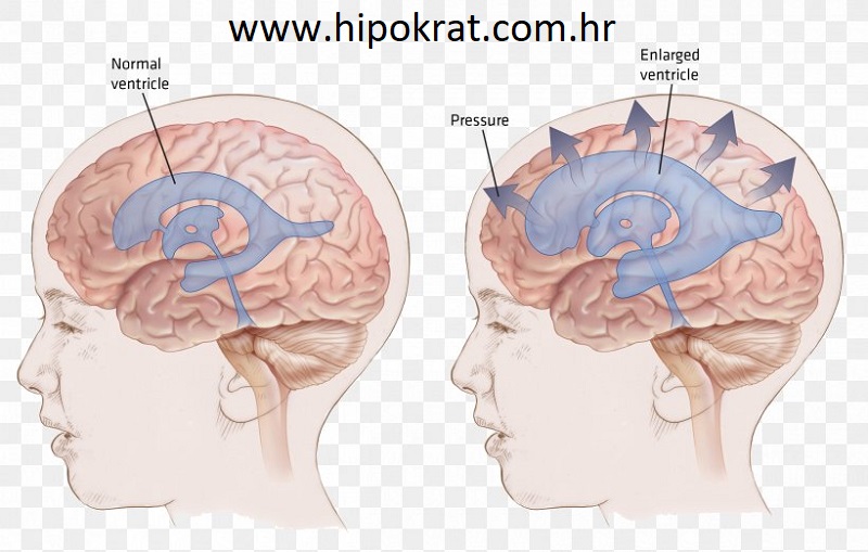 Hidrocefalus