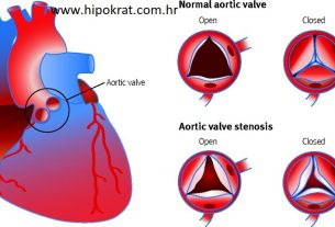 Aortna stenoza