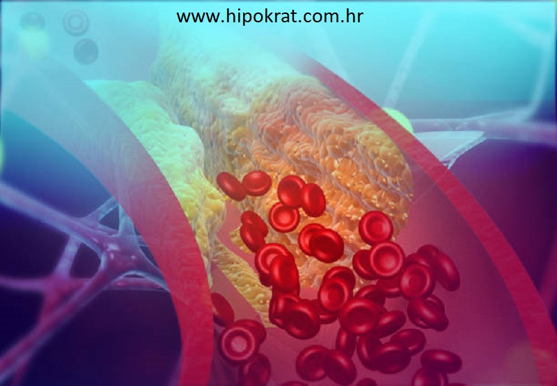 Kako očistiti krvne žile