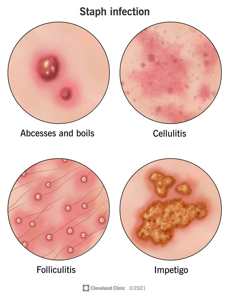 Staphylococcus aureus (zlatni stafilokok)