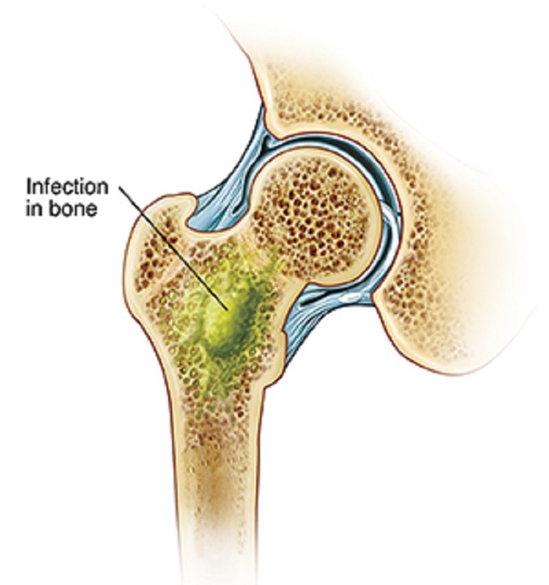 Osteomijelitis (infekcija kostiju)