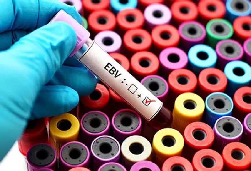 Epstein-Barr Virus (EBV) - uzrok, simptomi i liječenje