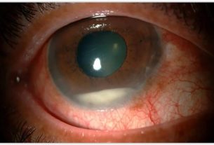 Endoftalmitis (infekcija unutar oka)